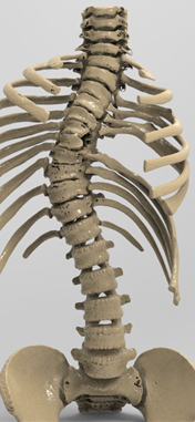 E:\大醫(yī)學2020-6-20\我做的醫(yī)學手術圖片2020-6-20\2018-8-26第一例應用3D打印技術做的脊柱側彎\微信圖片_20180822163238.png